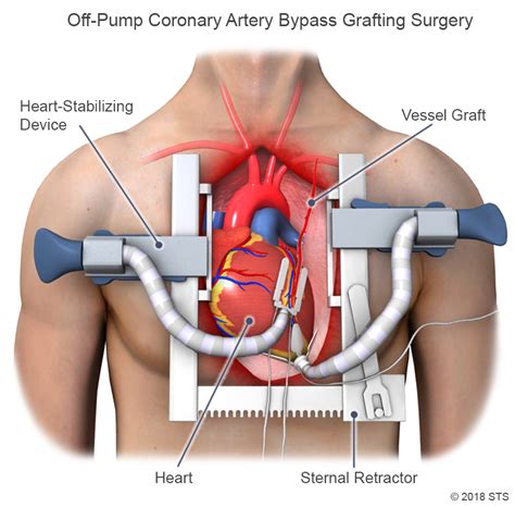 Coronary Artery Bypass Grafting (CABG) | The Patient Guide to Heart, Lung, and Esophageal Surgery