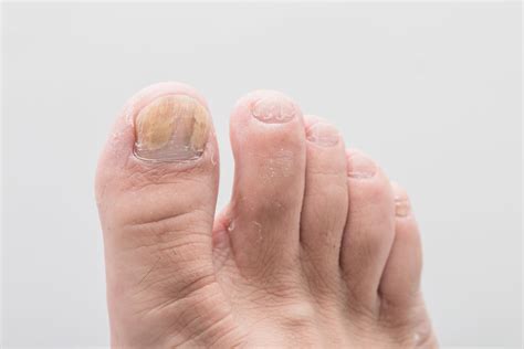 Toenail Fungus: Causes, Symptoms, and Treatment