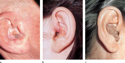 Skin Cancer On Ear Cartilage
