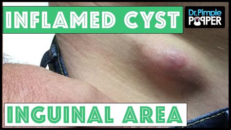 Inflamed Egg-Shaped Cyst Removed, Right inguinal area | Epidermoid cyst, Cysts, Pimple popping