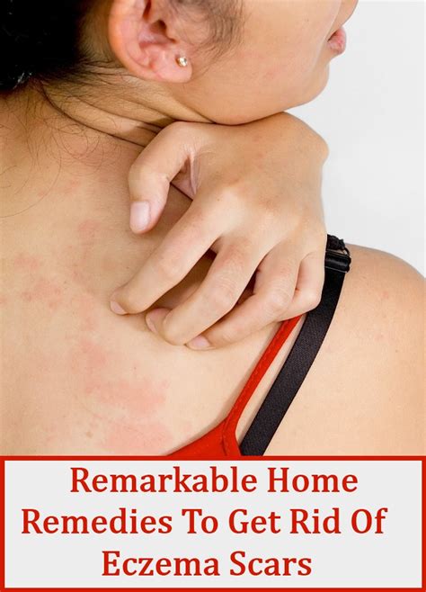 7 Remarkable Home Remedies To Get Rid Of Eczema Scars! – Natural Home ...