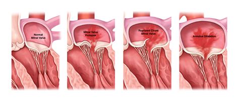 Mitral Valve Regurgitation Causes, Symptoms & Treatment