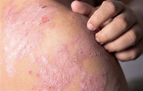 Eczema: causes and symptoms | Emergency Live