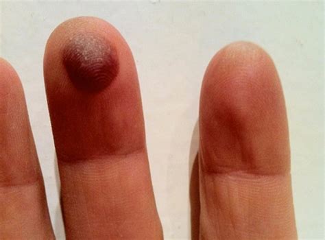 Healthoolblood blister on finger pictures 2 | Healthool