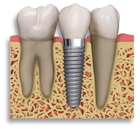 La Porte Texas Dental Implants | La Porte Dentist.