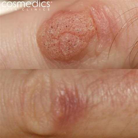 Warts and Wart Treatment | London Mole Removal