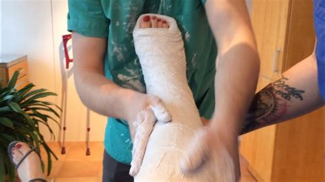 Love casts? (Leg cast, plaster cast, crutches, sprained ankle) - YouTube