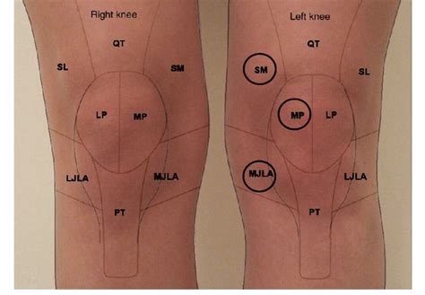 Knee Pain Location Chart