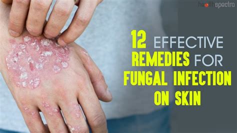 12 Effective Remedies For Fungal Infection On Skin | Healthspectra ...