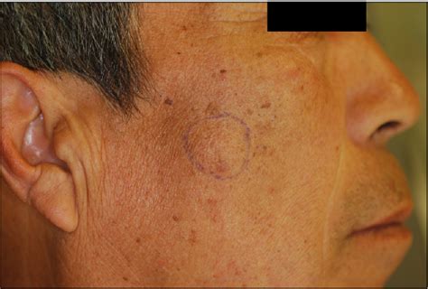 Figure 1 from A Case of Acinic Cell Carcinoma Involving Skin | Semantic ...