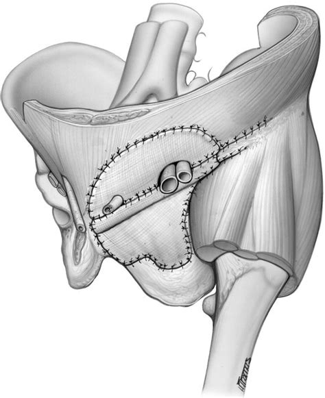 En bloc resection of extra-peritoneal soft tissue neoplasms incorporating a type III internal ...