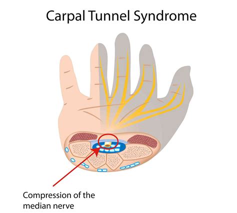 Explainer: what is carpal tunnel syndrome and what happens if I get it?