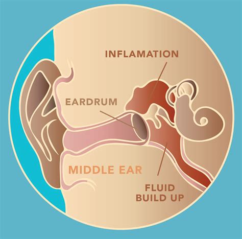 What a Middle Ear Infection Looks Like - NUTRITION LINE