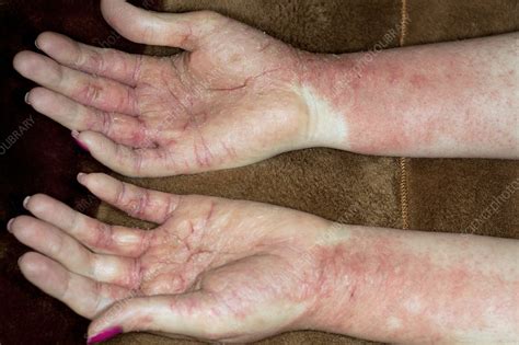 Allergic Contact Dermatitis Hands