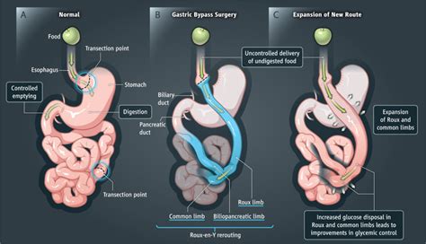 Best Laparoscopic Roux-en-Y Gastric Bypass Surgery in Mumbai, India | Bestbariatricsurgeon.org