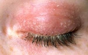 Eyelid Infection - Pictures, Causes, Treatment, Remedies