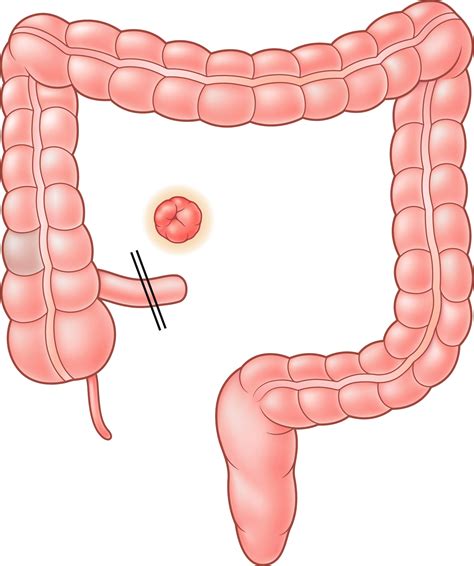 Management of Crohn’s disease and ulcerative colitis - Surgery - Oxford ...