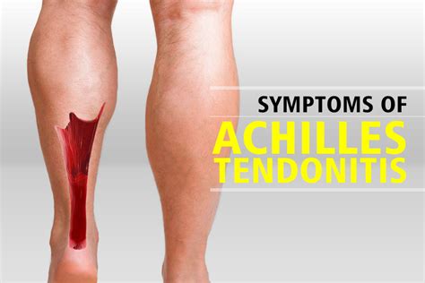 The Causes and Symptoms of Achilles Tendonitis – ActiveGear