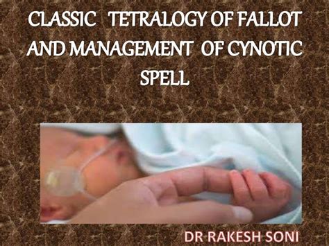 TETRALOGY OF FALLOT AND TET SPELL presentation