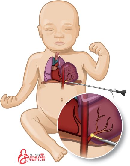 Download Graphic Of Baby With Bronchopulmonary Sequestration - Bronchopulmonary Sequestration ...