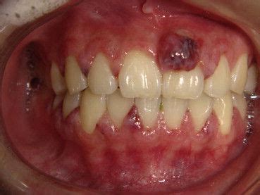 How Long Does Gingivitis Last? - The Truth - 1311 Jackson Ave Dental | Dentist in Long Island ...