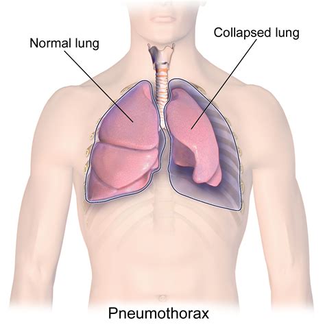 Condition Specific Radiology: Pneumothorax - Stepwards