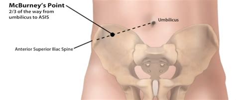 Manuver-Manuver Khusus Untuk Pemeriksaan Apendisitis | Arga Aditya