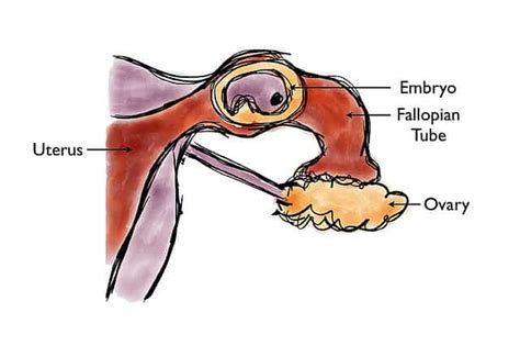 Ectopic Pregnancy - almostadoctor