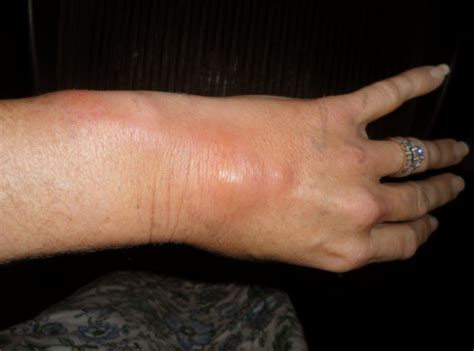 Flebitis En La Mano