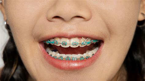 Braces with Rubber Bands: Purpose and How Long They Stay On