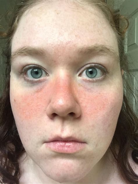 Does anyone else’s butterfly rash show up when you’ve been out in the sun? (Pic) : r/lupus