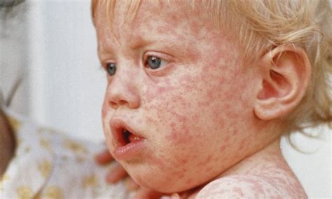 Measles rash