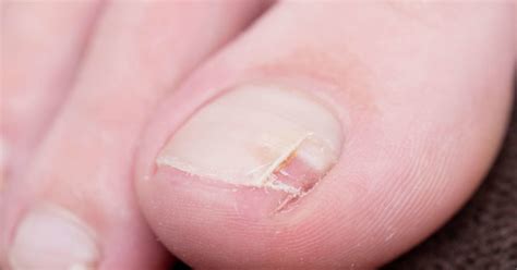 How to fix a split nail: Causes, treatment, and prevention