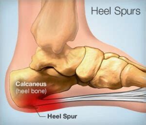 How To Get Rid Of A Bone Spur Without Surgery?