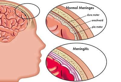 Meningitis Symptoms Stiff Neck