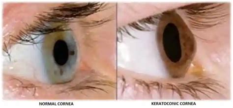 Keratoconus Treatment: Get the Best Care for Your Eyes