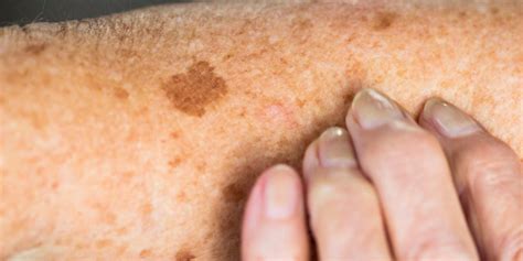 Skin Sunspots (Aka Age Spots): Causes, Prevention, and How to Get Rid of Them