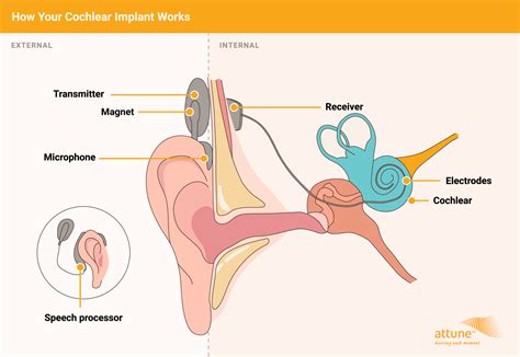 What are Cochlear Implants? - Attune