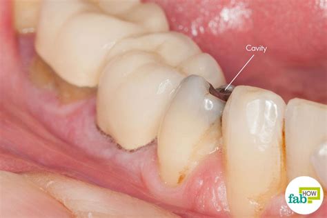 How to Get Rid of Cavities and Heal Tooth Decay | Fab How