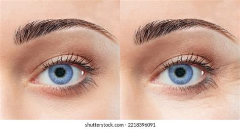 Women Eye Before After Cream Stock Photo 2218396091 | Shutterstock