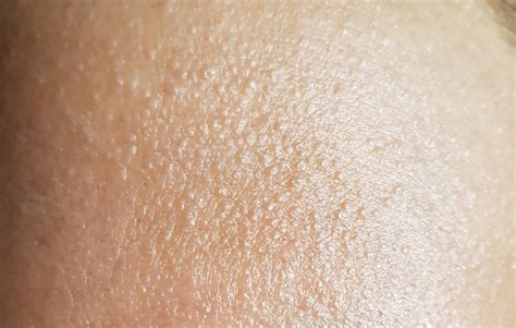 Small Skin Colored Bumps On Arms And Legs Naturalskins | Images and Photos finder