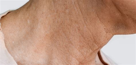 Neck Wrinkles - Causes, Prevention, Treatment Options and more