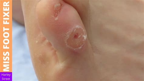 SATISFYING CORN REMOVAL FROM TOE MISS FOOT FIXER - YouTube
