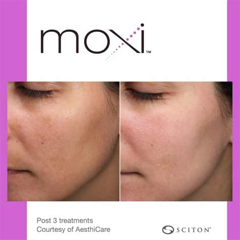 MOXI Laser Treatment | Illume Cosmetic Surgery & MedSpa