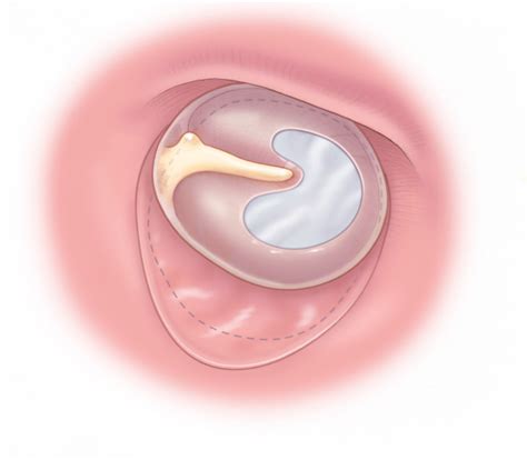 Tympanic Membrane Perforation | Otolaryngology⁠ — Head & Neck Surgery ...