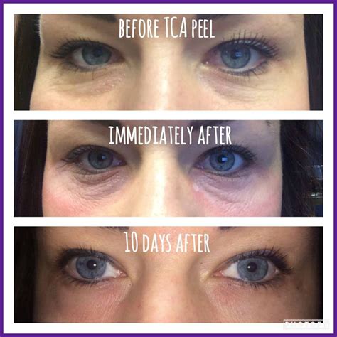 under eye tca peel before and after - genaro-moddejonge