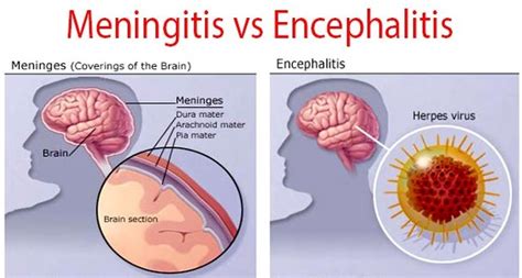 Badan Sehat Dan Ideal Pakai Smart Detox: Penyakit Encephalitis adalah ...