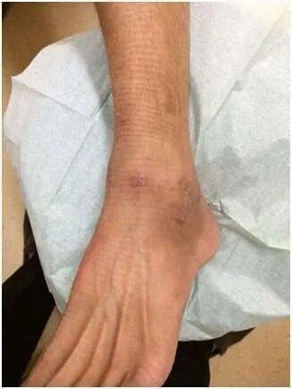 Ankle Ligament Tear: Causes, Symptoms, and Treatment Options ...