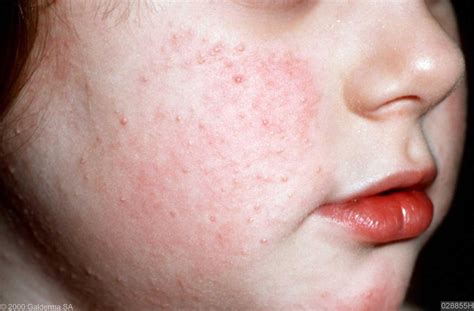 What Causes Keratosis Pilaris In Children How To Trea - vrogue.co