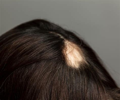 Hair loss due to ringworm of the scalp | Ducray